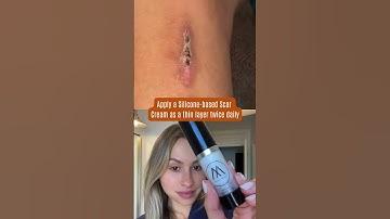 This is How this Silicone- based Scar Cream will HEAL your Scars!