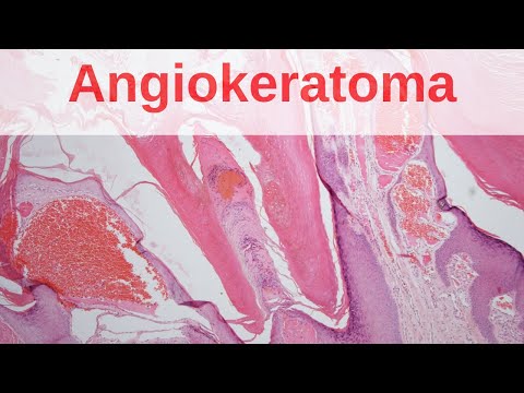 Angiokeratoma of Mibelli - Pathology mini tutorial