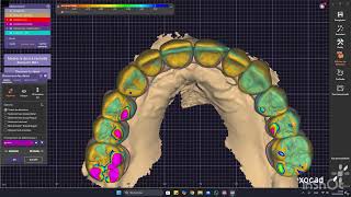 Conception Thimble Crown 🦷👉🇹🇳#dentalcadcam#exocad#dentaldesign#Fullarch#Dental#implant#أسنان