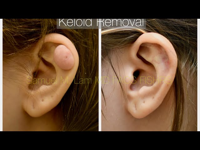 Ear Keloid Removal Testimonial in Dallas, Texas with Photos