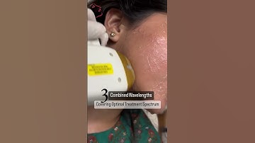 Soprano ICE Platinum Laser Hair Removal