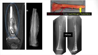 Osteosarcoma of Distal Femur Knee Resimi