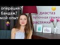 Восстановление фигуры после родов, диастаз, пупочная грыжа и растяжки. Мой опыт