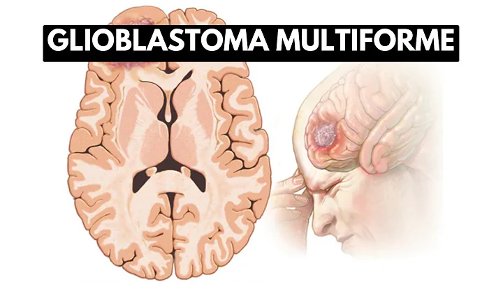 Inside Glioblastoma Multiforme: A Journey into the Deadliest Brain Tumor - DayDayNews