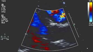 Is The Pa Pressure High Or Low? Echo Challenge