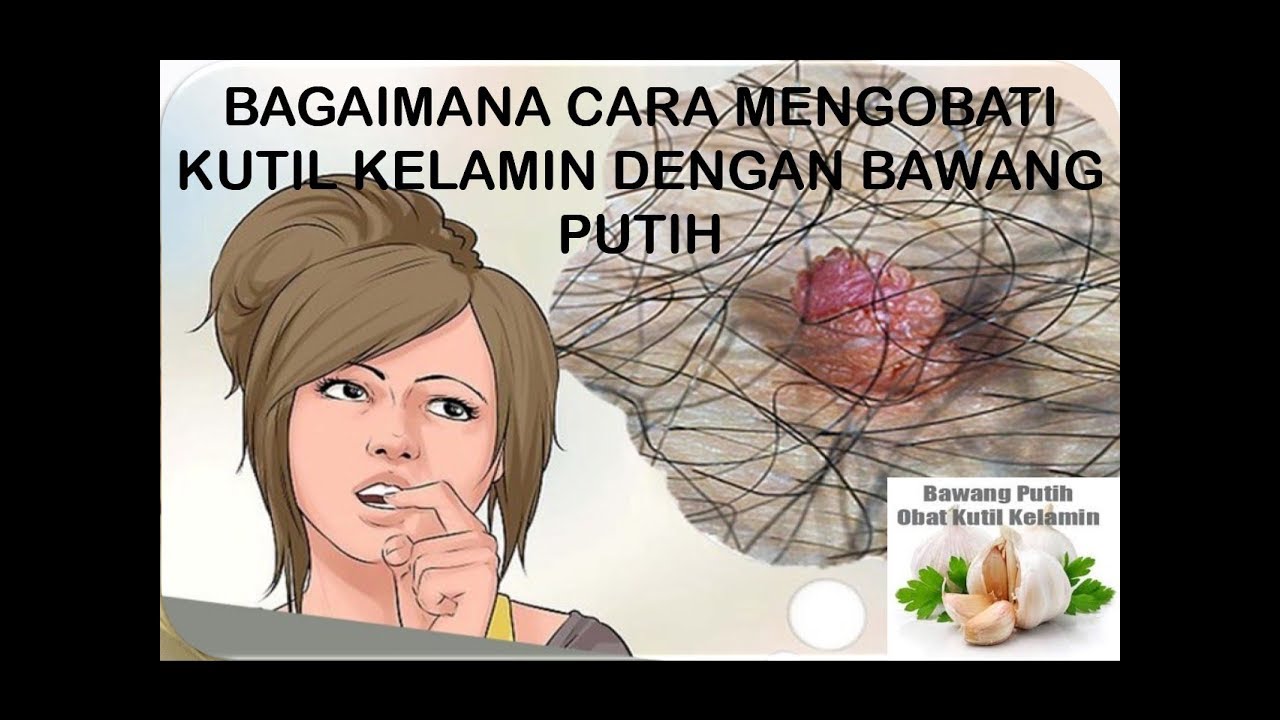 BAGAIMANA CARA MENGOBATI KUTIL KELAMIN DENGAN BAWANG PUTIH 