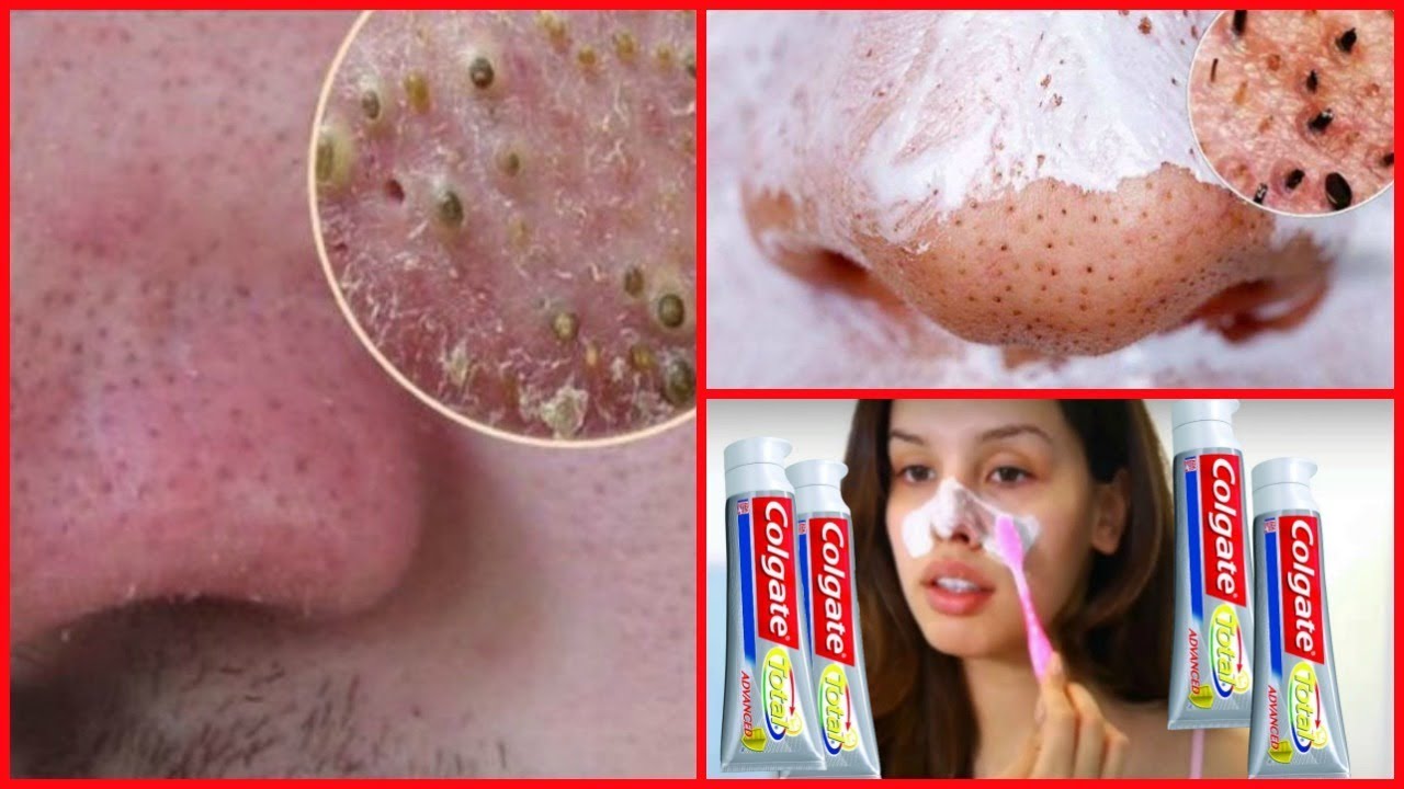mascarilla casera para eliminar puntos negro en la nariz