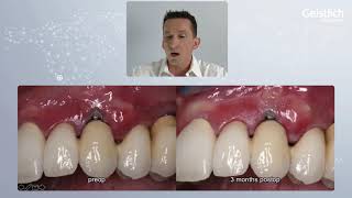 Geistlich Webinar Soft Tissue Regeneration - Dr  Marcus Beschnidt screenshot 4