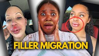 Exposing Lip Filler Migration