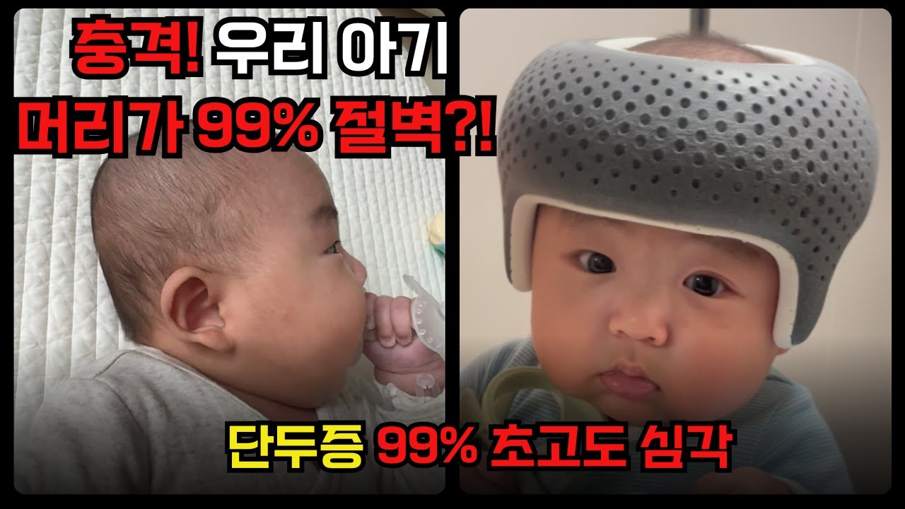 우리 아기 뒤통수가 99% 절벽? (250만원 헬멧을 맞춘 이유)