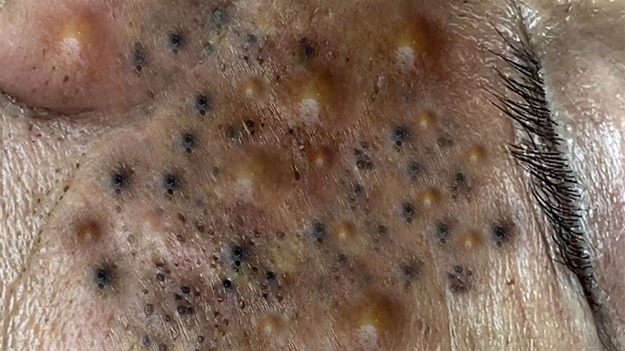 TREATMENT OF BIG BLACKHEADS AND HIDDEN ACNE FOR THE ELDERLY