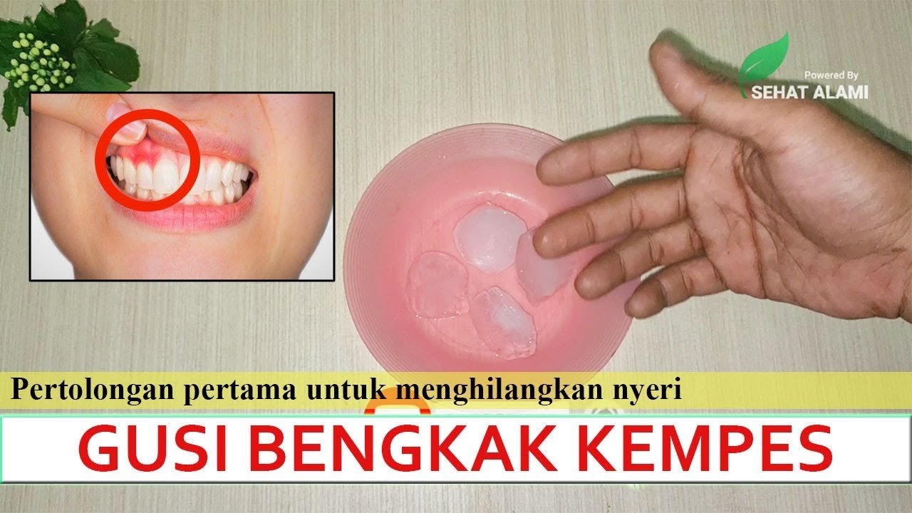 Kempes Seketika|Cara mengobati gusi bengkak dengan cepat