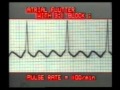 Learning ECG - Atrial Flutter