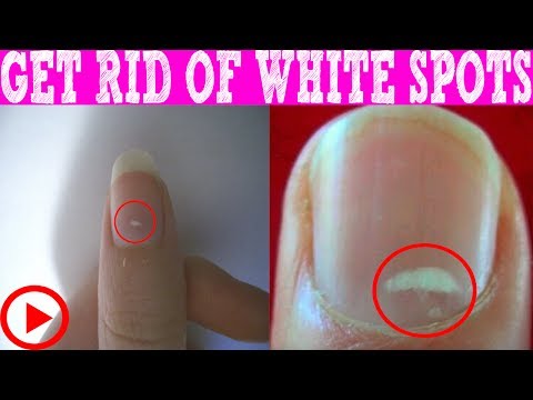 How to Get Rid of White Spots on Nails within 3 days | White Spots On Nails What It Really Means.