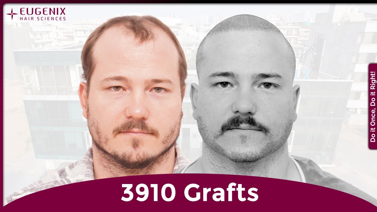 Why I Chose India Over Turkey for My Hair & Beard Transplant | Russell’s Story at Eugenix