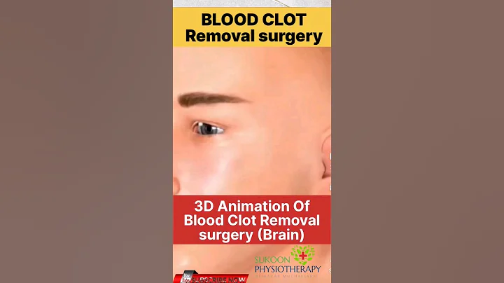 blood clot removal surgery animation/ brain clots surgery #shorts #short #youtubeshorts #brain