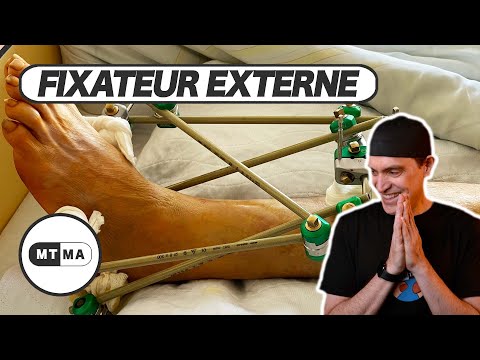 Video: Schmerzen externe Fixateure?