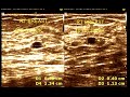 Multiple small hypoechoic and cystic mass  cystic lesion breast