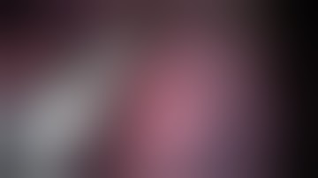 UVATS right basal segmentectomy