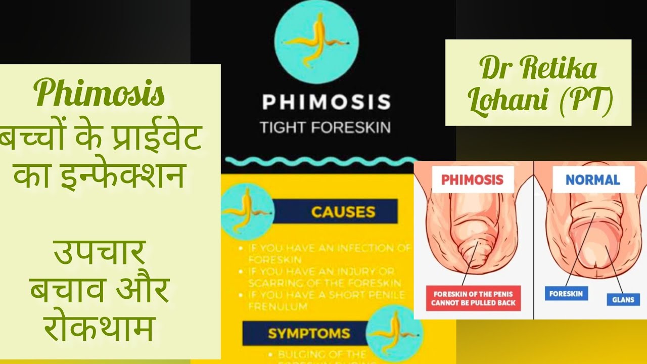 Boys foreskin infection PHIMOSIS उपचार, रोकथाम और बचाव (Hindi)How To