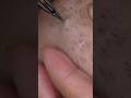 061 #tweezers #hairremoval #毛抜き