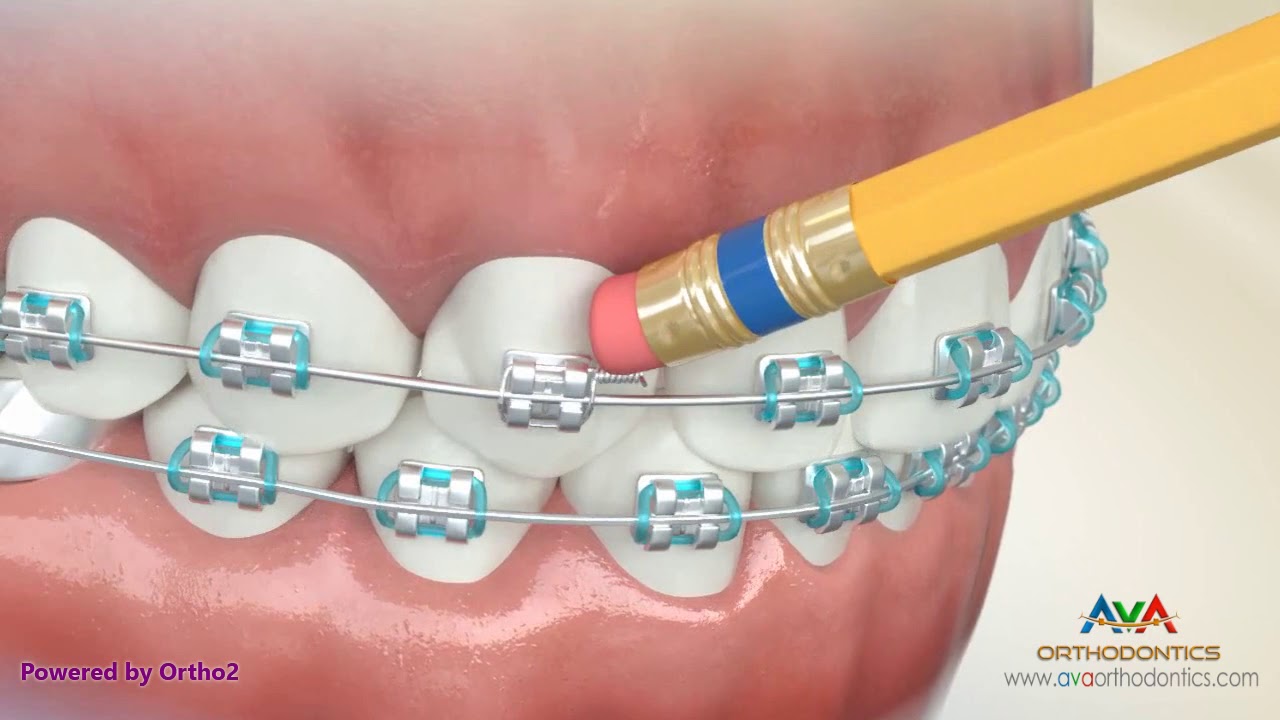 What to do when I have an orthodontic wire sticking out and poking the gums?