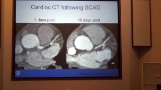 2016 Presentation of Latest Research Findings by Cardiologist Dr Sharonne Hayes