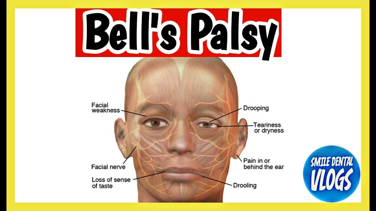 Bell's Palsy Facial Nerve Paralysis Smile Dental VLOGS Part 2 YouTube
