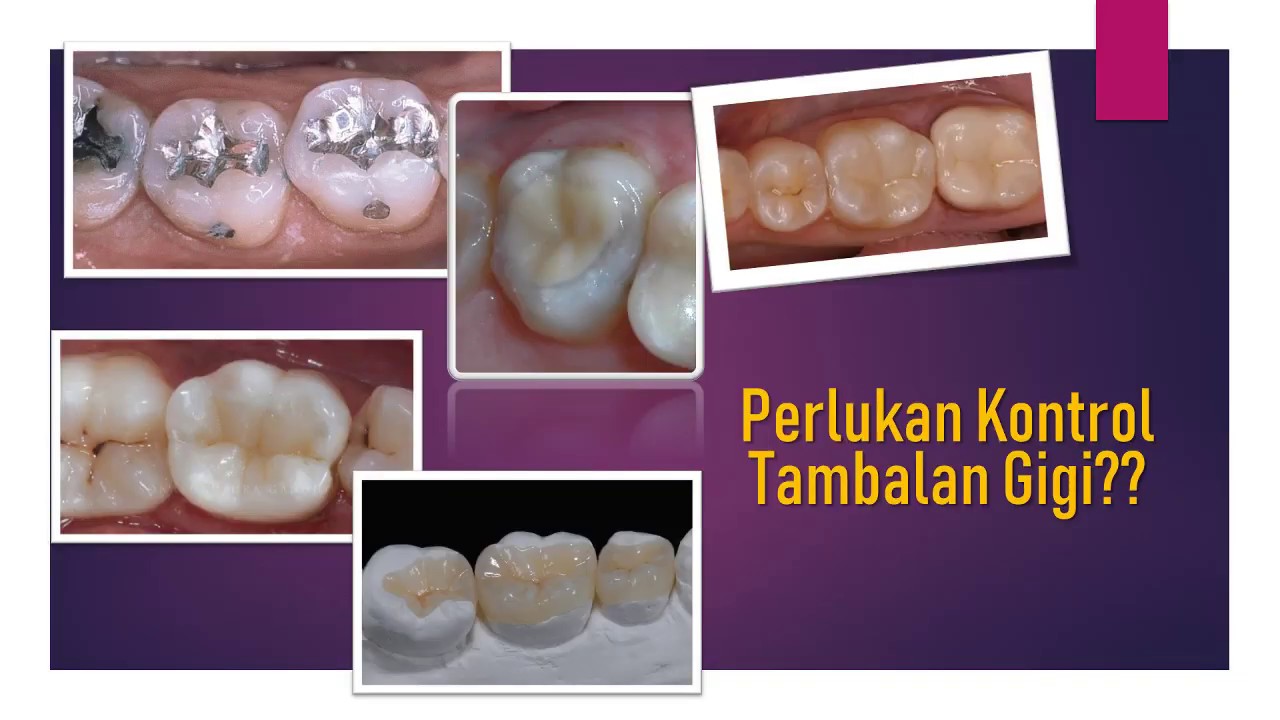 PERLUKAH KONTROL TAMBALAN GIGI?? 