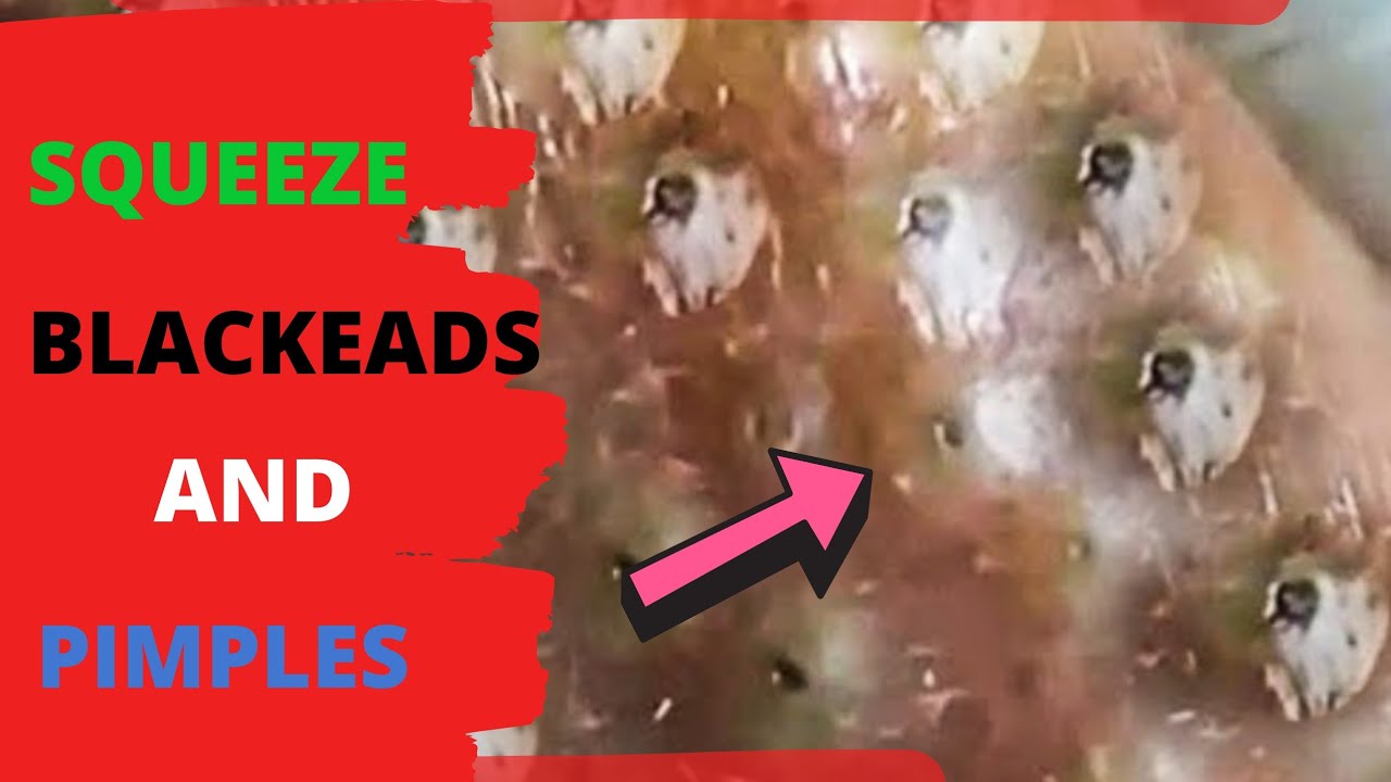 SQUEEZE BLACKHEADS and PIMPLES...😱😱😱 YouTube