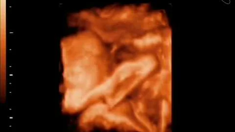 Gavin Brody Hammond - 3D Ultrasound - 30 Weeks - 1...