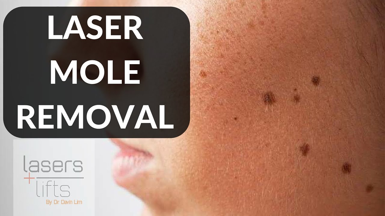 How to remove moles at home - Charlotte in England