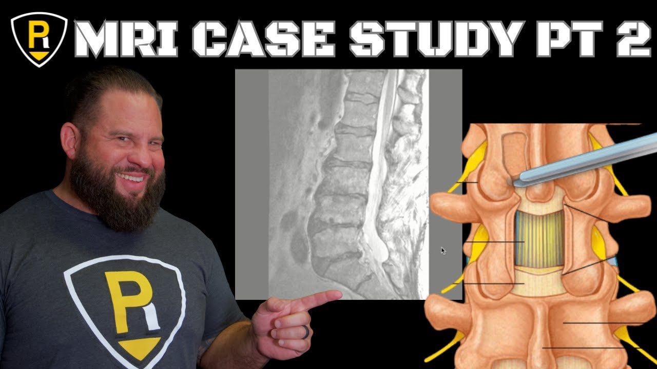 Пример из практики МРТ, часть 2: неудачная ламинэктомия и многое другое