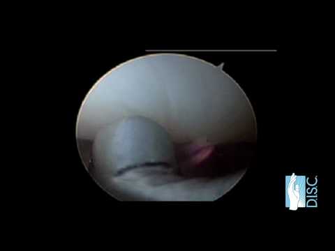 Wrist Arthroscopy Surgery