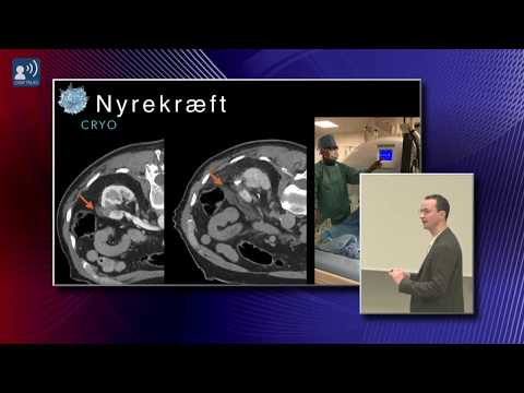 Video: Nyrecancer: Levealder Og Prognose Efter Fase