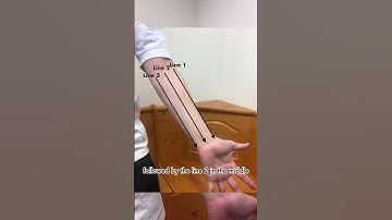 Spoon Technique for Trigger Finger (Part 5) on Forearm #triggerfinger #triggerthumb