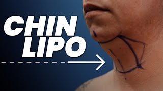 Chin Lipo: Say Goodbye to Double Chin 👋🏻