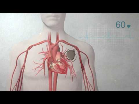 Video: What is PACE. Abbreviation decoding