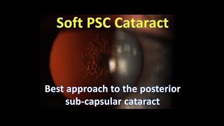 Soft PSC: Posterior Sub-Capsular Cataract Surgery Made Easy screenshot 1