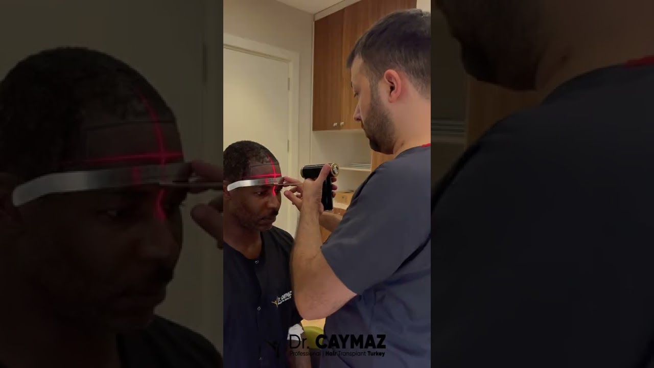 Afro American Hairline and Incision Process by Dr CAYMAZ's Vip Hair Transplant Operation