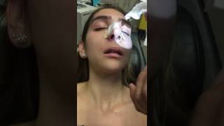 Removing A Nasal Stent 5 Days After Rhinoplasty