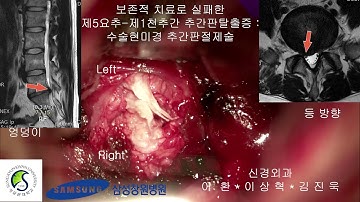 보존적치료하였으나증상호전이 없었던추간판탈출증수술현미경추간판절제술