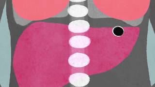 What is secondary breast cancer?