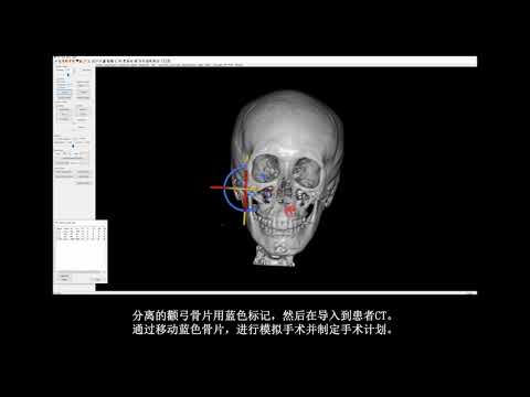 [H整形医院] 3D Fit钛板假体