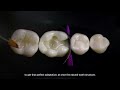 Repairing Posterior Cavities Esthetically with BULKfill