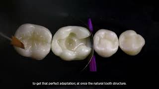 Repairing Posterior Cavities Esthetically with BULKfill