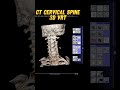 3D VRT filming of CT Cervical Spine | #ctscan #ctscanner #mri #radiology #radiographer #radiography