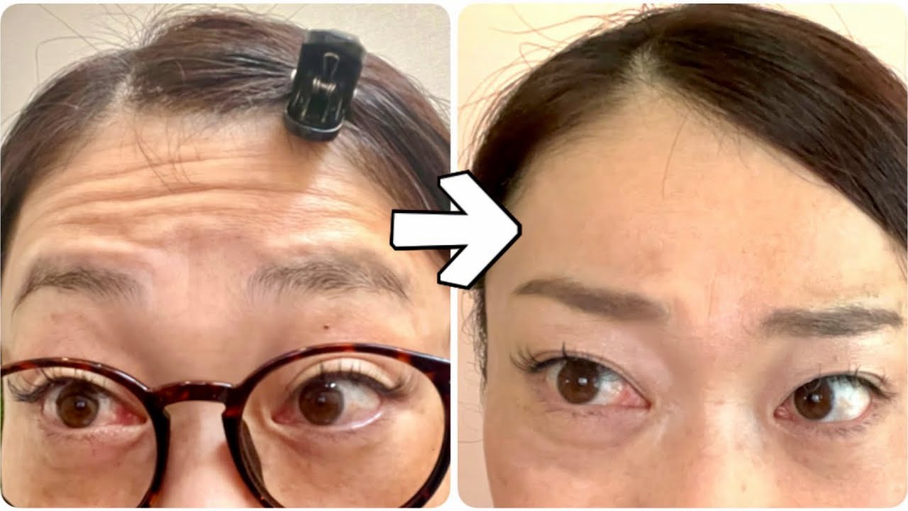 【人生初ボトックス】痛い？効果は？実際の施術も全て公開致します‼︎