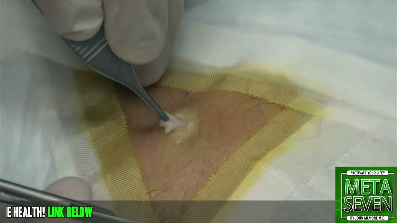 Punch Double Feature! Punch Biopsy and Punch Excision YouTube