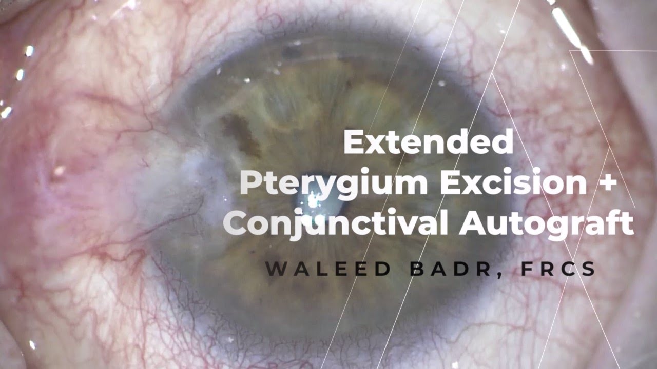 Extended Pterygium Excision with Conjunctival Autograft - YouTube